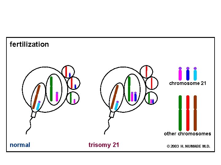 fertilization chromosome 21 other chromosomes normal trisomy 21 © 2003 H. NUMABE M. D.