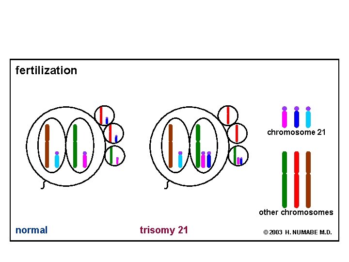 fertilization chromosome 21 other chromosomes normal trisomy 21 © 2003 H. NUMABE M. D.