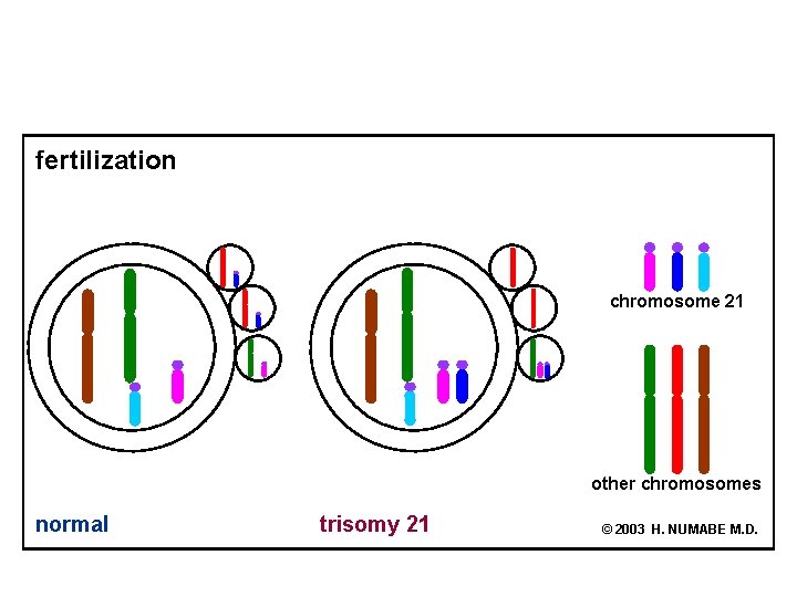 fertilization chromosome 21 other chromosomes normal trisomy 21 © 2003 H. NUMABE M. D.