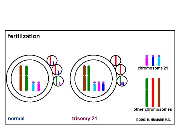 fertilization chromosome 21 other chromosomes normal trisomy 21 © 2003 H. NUMABE M. D.