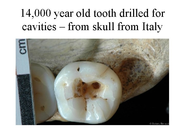 14, 000 year old tooth drilled for cavities – from skull from Italy 