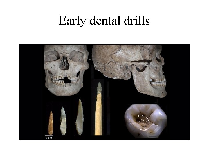 Early dental drills 