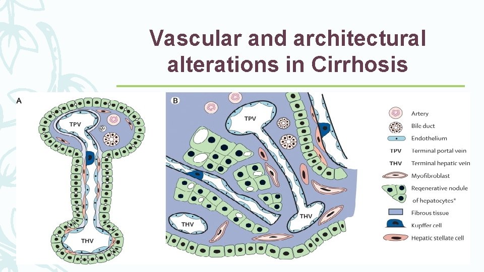 Vascular and architectural alterations in Cirrhosis Vascular and architectural alterations in Cirrhosis