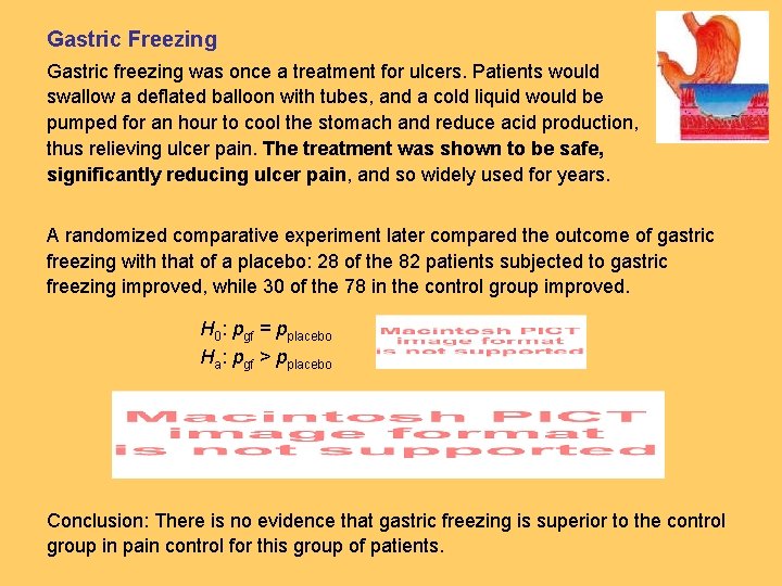 Gastric Freezing Gastric freezing was once a treatment for ulcers. Patients would swallow a