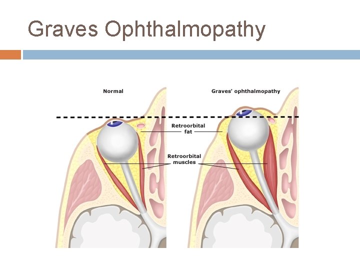 Graves Ophthalmopathy 