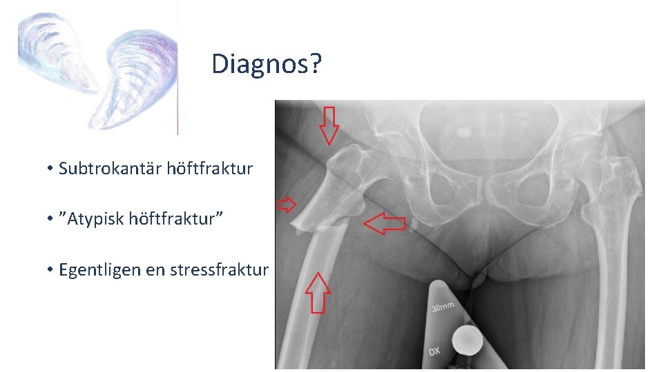 Diagnos? • Subtrokantär höftfraktur • ”Atypisk höftfraktur” • Egentligen en stressfraktur 