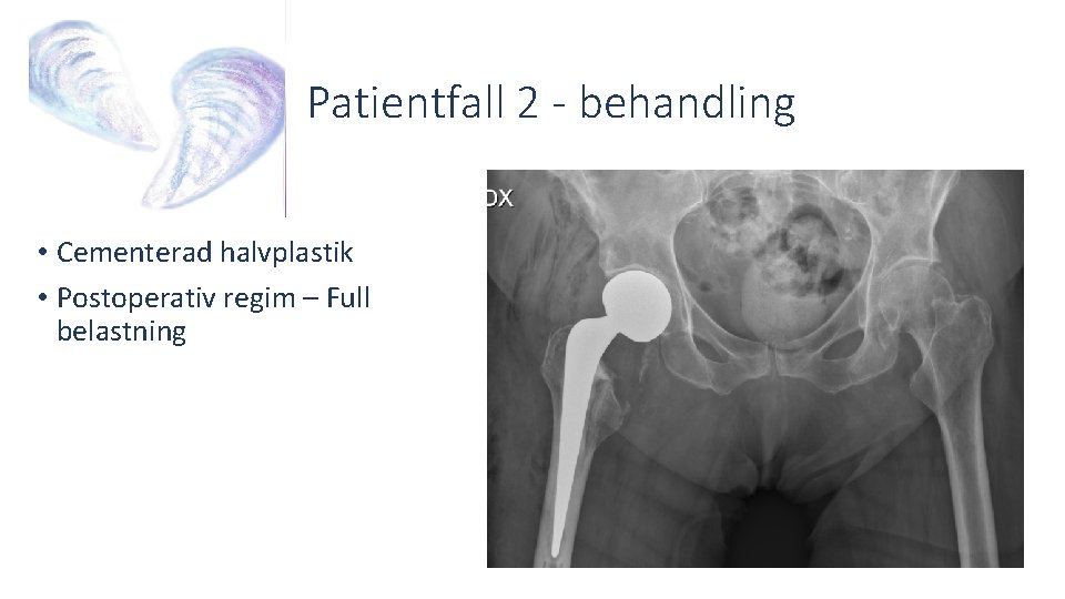 Patientfall 2 - behandling • Cementerad halvplastik • Postoperativ regim – Full belastning 