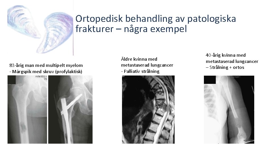 Ortopedisk behandling av patologiska frakturer – några exempel 83 -årig man med multipelt myelom