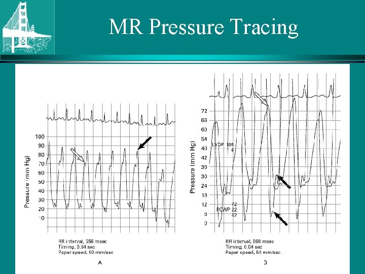 MR Pressure Tracing © Continuing Medical Implementation ® …. . . bridging the care