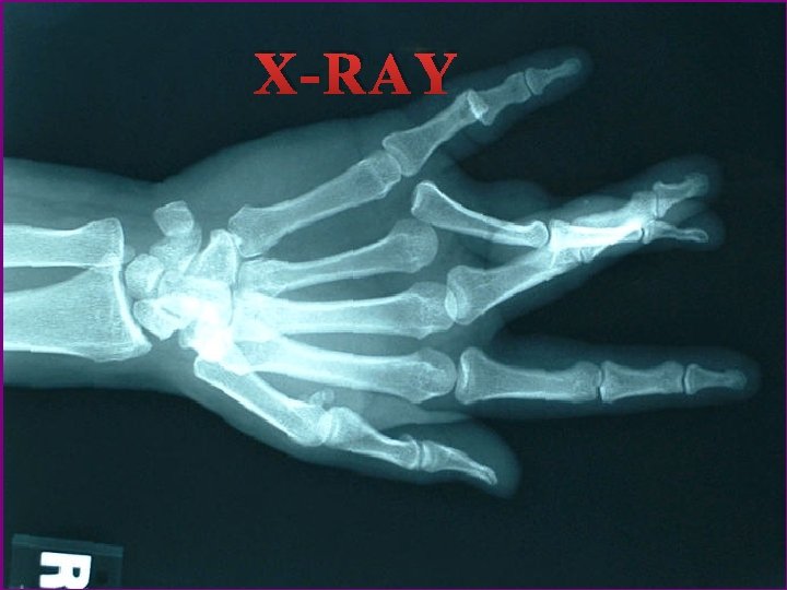 X-RAY 