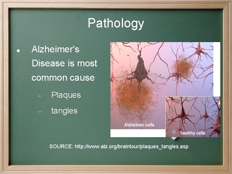 Pathology Alzheimer's Disease is most common cause Plaques tangles SOURCE: http: //www. alz. org/braintour/plaques_tangles.