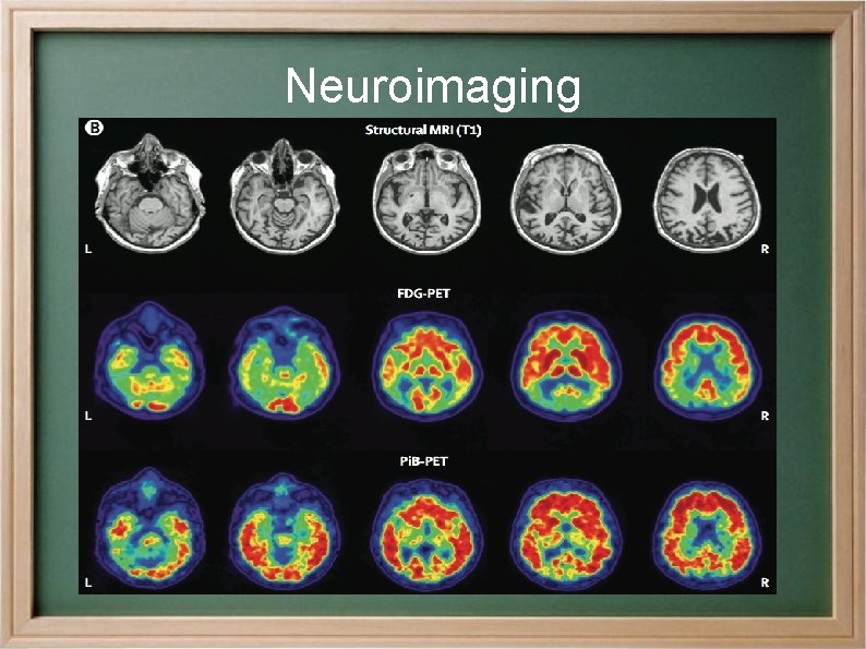 Neuroimaging 