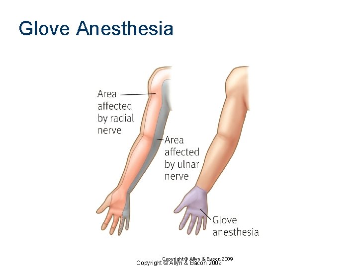 Glove Anesthesia Copyright © Allyn & Bacon 2009 