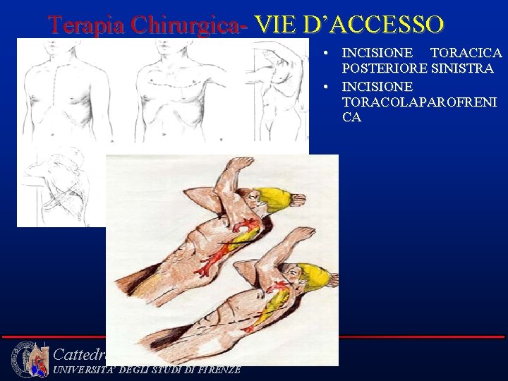 Terapia Chirurgica- VIE D’ACCESSO • INCISIONE TORACICA POSTERIORE SINISTRA • INCISIONE TORACOLAPAROFRENI CA Cattedra