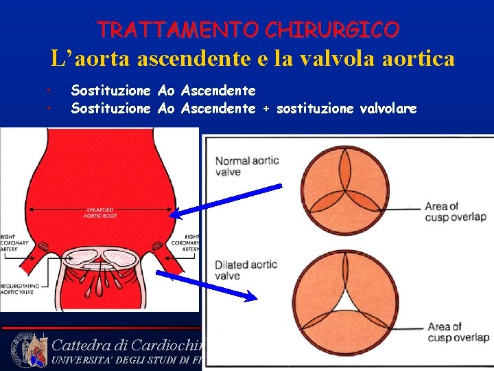  TRATTAMENTO CHIRURGICO L’aorta ascendente e la valvola aortica • • Sostituzione Ao Ascendente