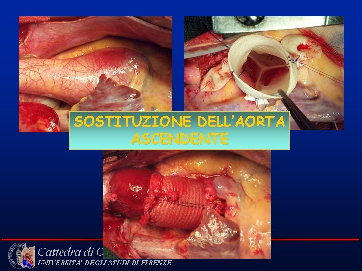 SOSTITUZIONE DELL’AORTA ASCENDENTE Cattedra di Cardiochirurgia UNIVERSITA’ DEGLI STUDI DI FIRENZE 