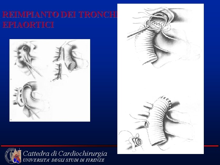 REIMPIANTO DEI TRONCHI EPIAORTICI Cattedra di Cardiochirurgia UNIVERSITA’ DEGLI STUDI DI FIRENZE 