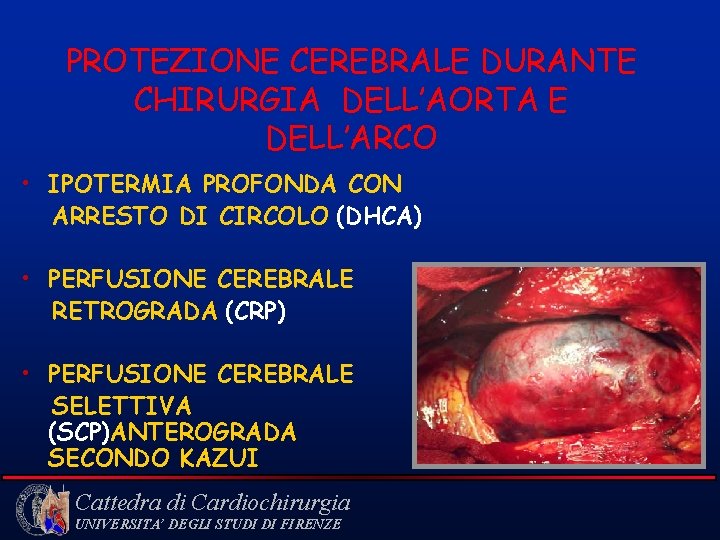 PROTEZIONE CEREBRALE DURANTE CHIRURGIA DELL’AORTA E DELL’ARCO • IPOTERMIA PROFONDA CON ARRESTO DI CIRCOLO