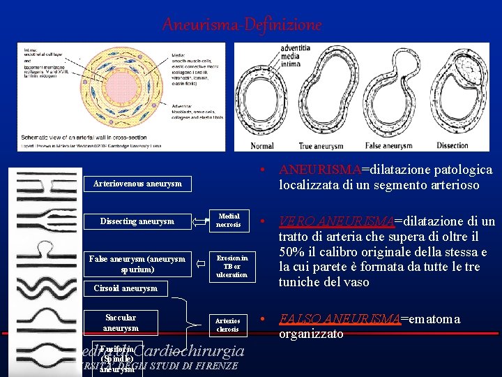 Aneurisma-Definizione • ANEURISMA=dilatazione patologica localizzata di un segmento arterioso Arteriovenous aneurysm Dissecting aneurysm False