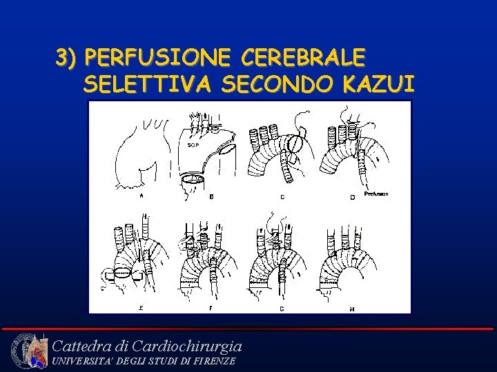 3) PERFUSIONE CEREBRALE SELETTIVA SECONDO KAZUI Cattedra di Cardiochirurgia UNIVERSITA’ DEGLI STUDI DI FIRENZE