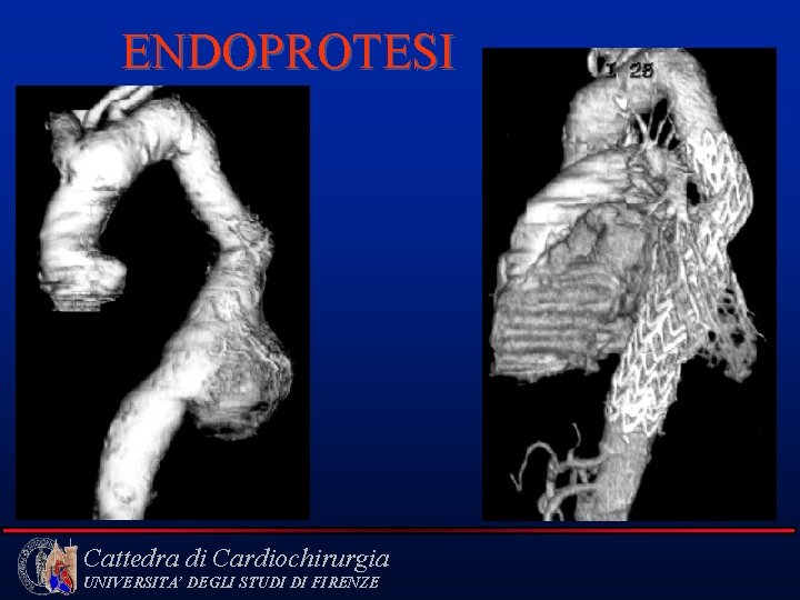 ENDOPROTESI Cattedra di Cardiochirurgia UNIVERSITA’ DEGLI STUDI DI FIRENZE 