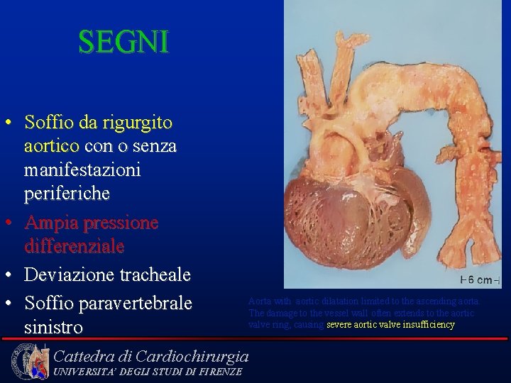 SEGNI • Soffio da rigurgito aortico con o senza manifestazioni periferiche • Ampia pressione