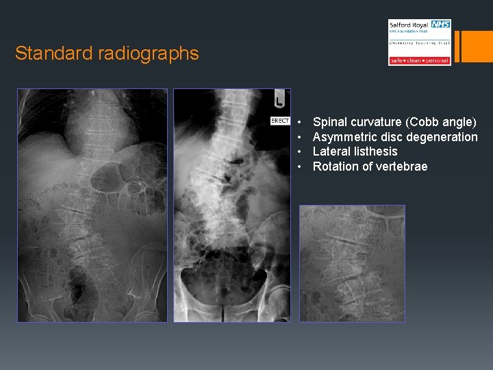 Standard radiographs • • Spinal curvature (Cobb angle) Asymmetric disc degeneration Lateral listhesis Rotation