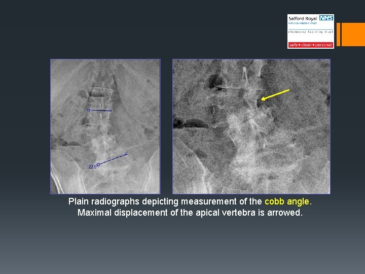 Plain radiographs depicting measurement of the cobb angle. Maximal displacement of the apical vertebra