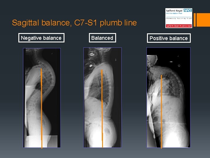 Sagittal balance, C 7 -S 1 plumb line Negative balance Balanced Positive balance 