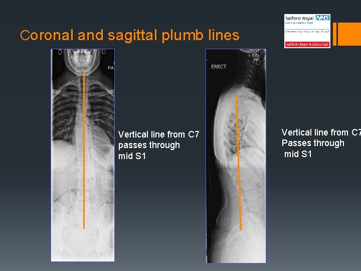 Coronal and sagittal plumb lines Vertical line from C 7 passes through mid S