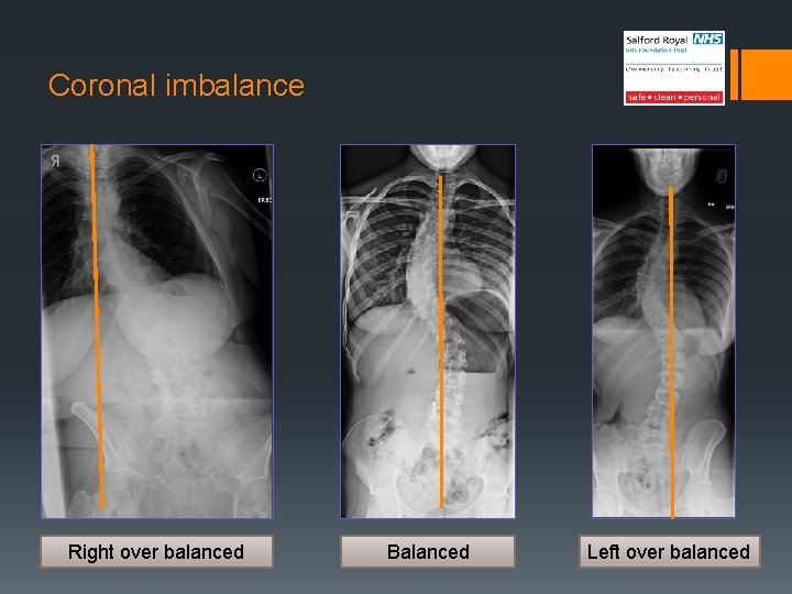 Coronal imbalance Right over balanced Balanced Left over balanced 