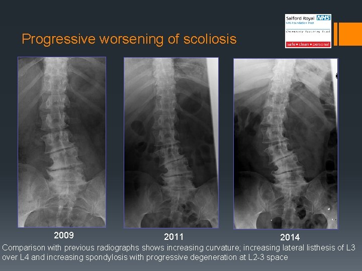 Progressive worsening of scoliosis 2009 2011 2014 Comparison with previous radiographs shows increasing curvature;