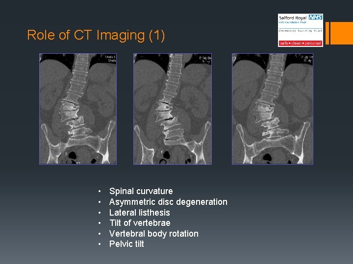 Role of CT Imaging (1) • • • Spinal curvature Asymmetric disc degeneration Lateral