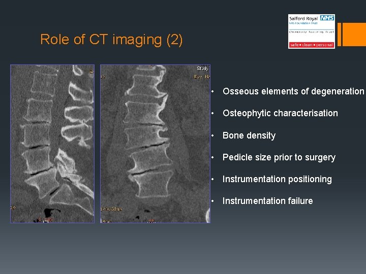 Role of CT imaging (2) • Osseous elements of degeneration • Osteophytic characterisation •