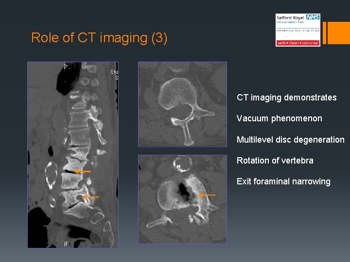 Role of CT imaging (3) CT imaging demonstrates Vacuum phenomenon Multilevel disc degeneration Rotation