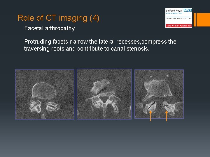 Role of CT imaging (4) Facetal arthropathy Protruding facets narrow the lateral recesses, compress