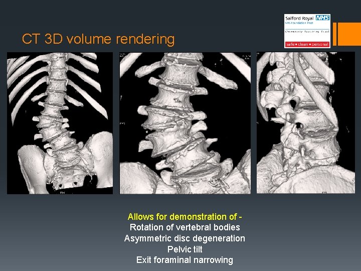 CT 3 D volume rendering Allows for demonstration of Rotation of vertebral bodies Asymmetric