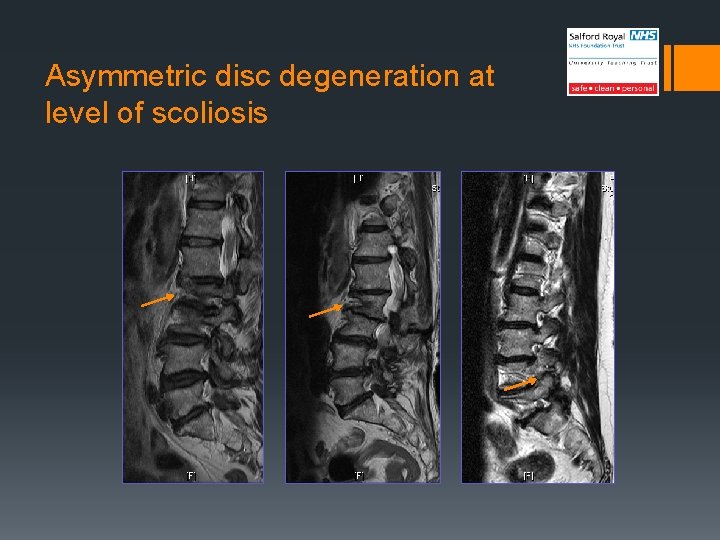 Asymmetric disc degeneration at level of scoliosis 