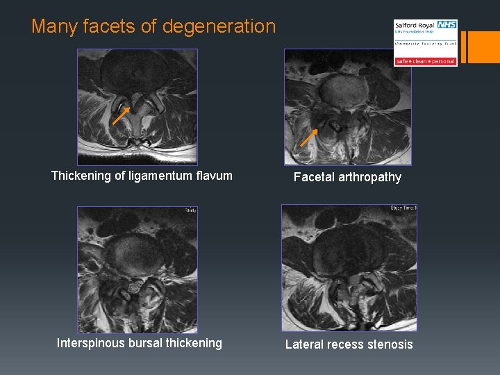 Many facets of degeneration Thickening of ligamentum flavum Facetal arthropathy Interspinous bursal thickening Lateral