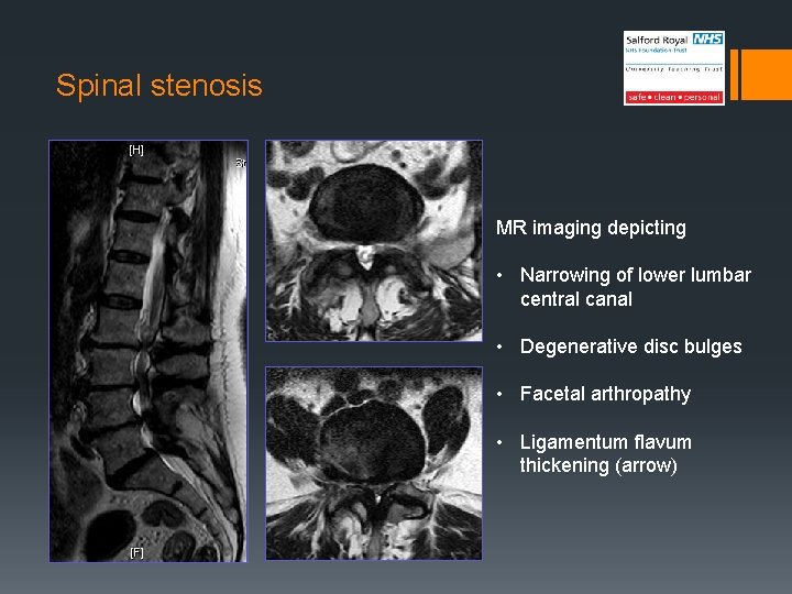 Spinal stenosis MR imaging depicting • Narrowing of lower lumbar central canal • Degenerative