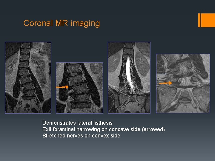 Coronal MR imaging Demonstrates lateral listhesis Exit foraminal narrowing on concave side (arrowed) Stretched