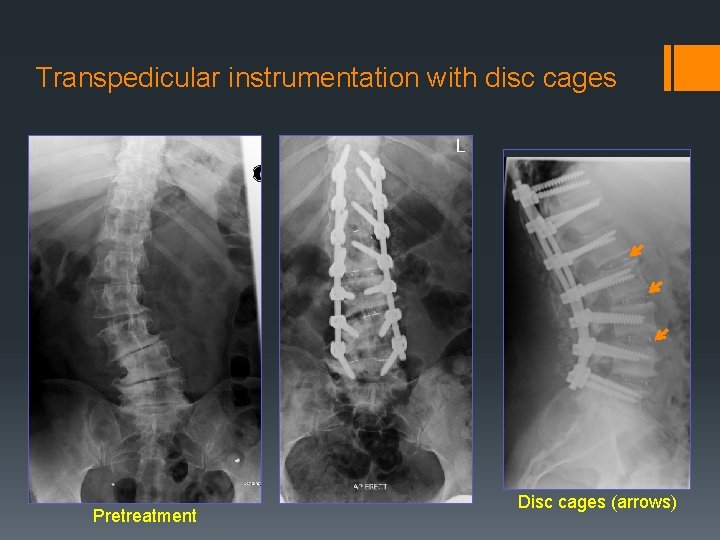 Transpedicular instrumentation with disc cages Pretreatment Disc cages (arrows) 