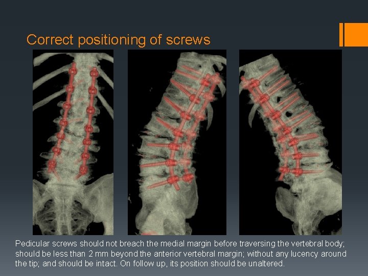 Correct positioning of screws Pedicular screws should not breach the medial margin before traversing