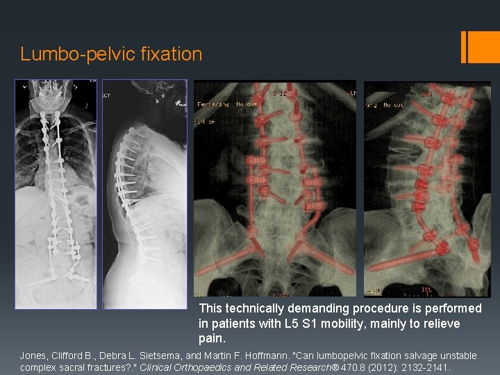 Lumbo-pelvic fixation This technically demanding procedure is performed in patients with L 5 S