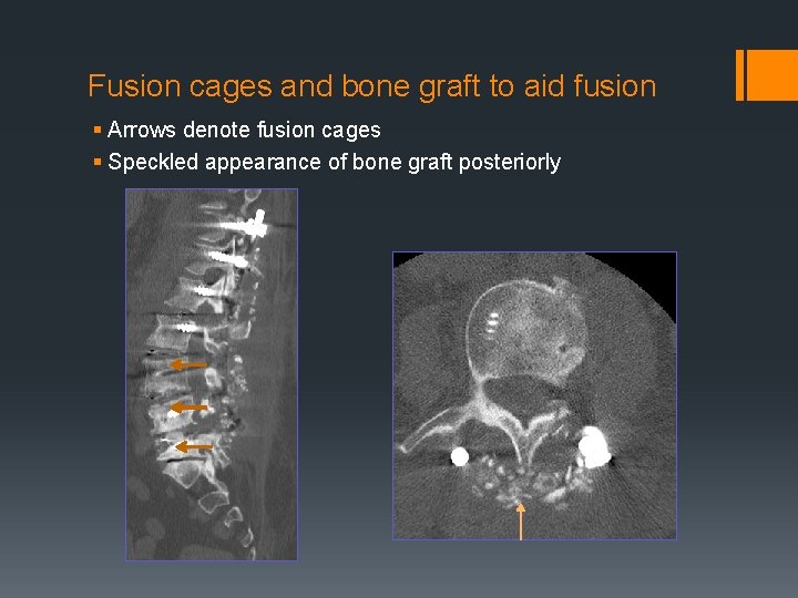 Fusion cages and bone graft to aid fusion § Arrows denote fusion cages §