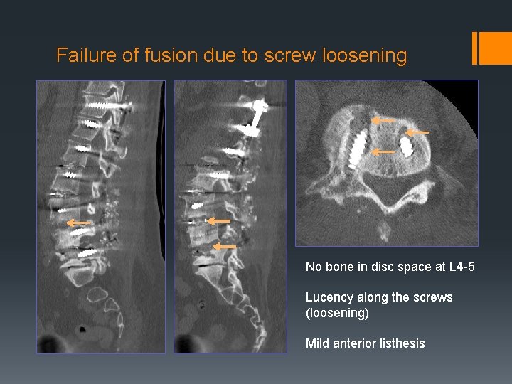Failure of fusion due to screw loosening No bone in disc space at L