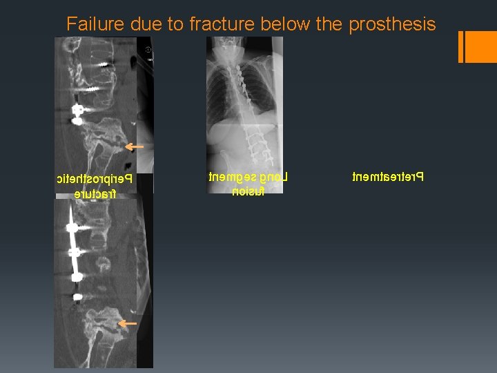 Failure due to fracture below the prosthesis citehtsorpire. P erutcarf tnemges gno. L noisuf