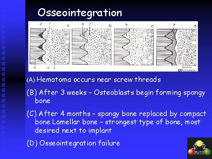 Osseointegration (A) Hematoma occurs near screw threads (B) After 3 weeks – Osteoblasts begin