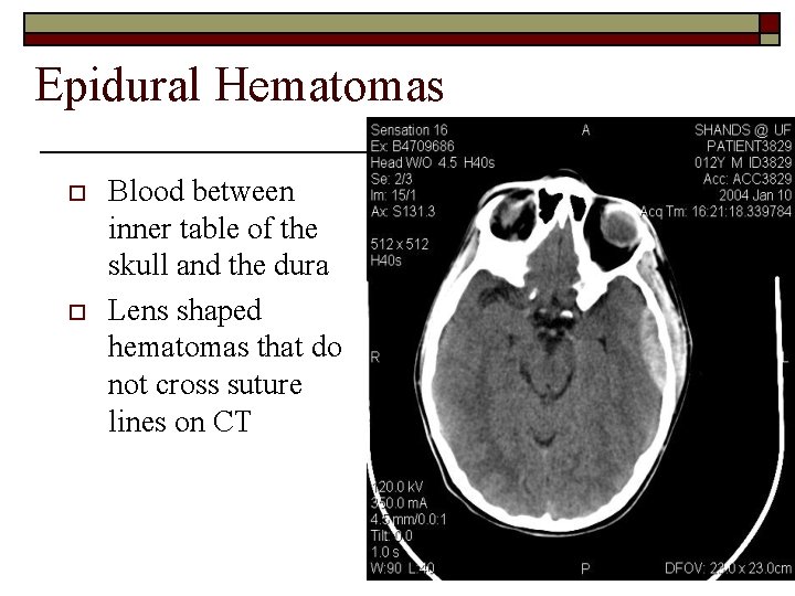 Epidural Hematomas o o Blood between inner table of the skull and the dura