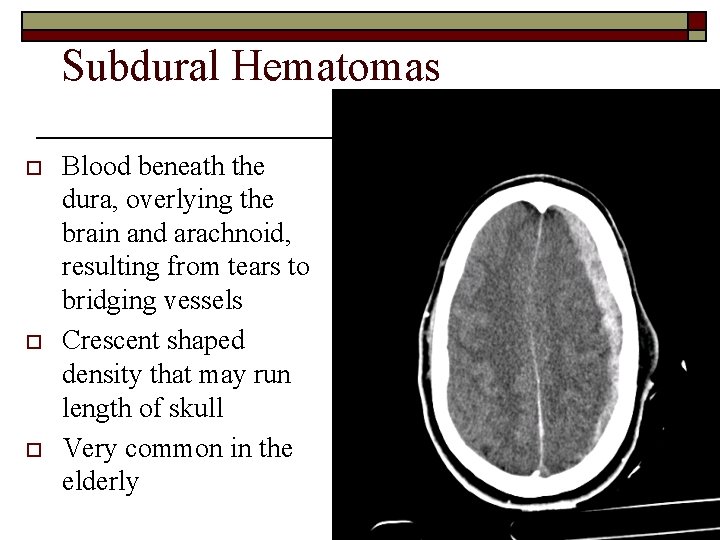 Subdural Hematomas o o o Blood beneath the dura, overlying the brain and arachnoid,